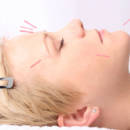 lifting-acupuntura